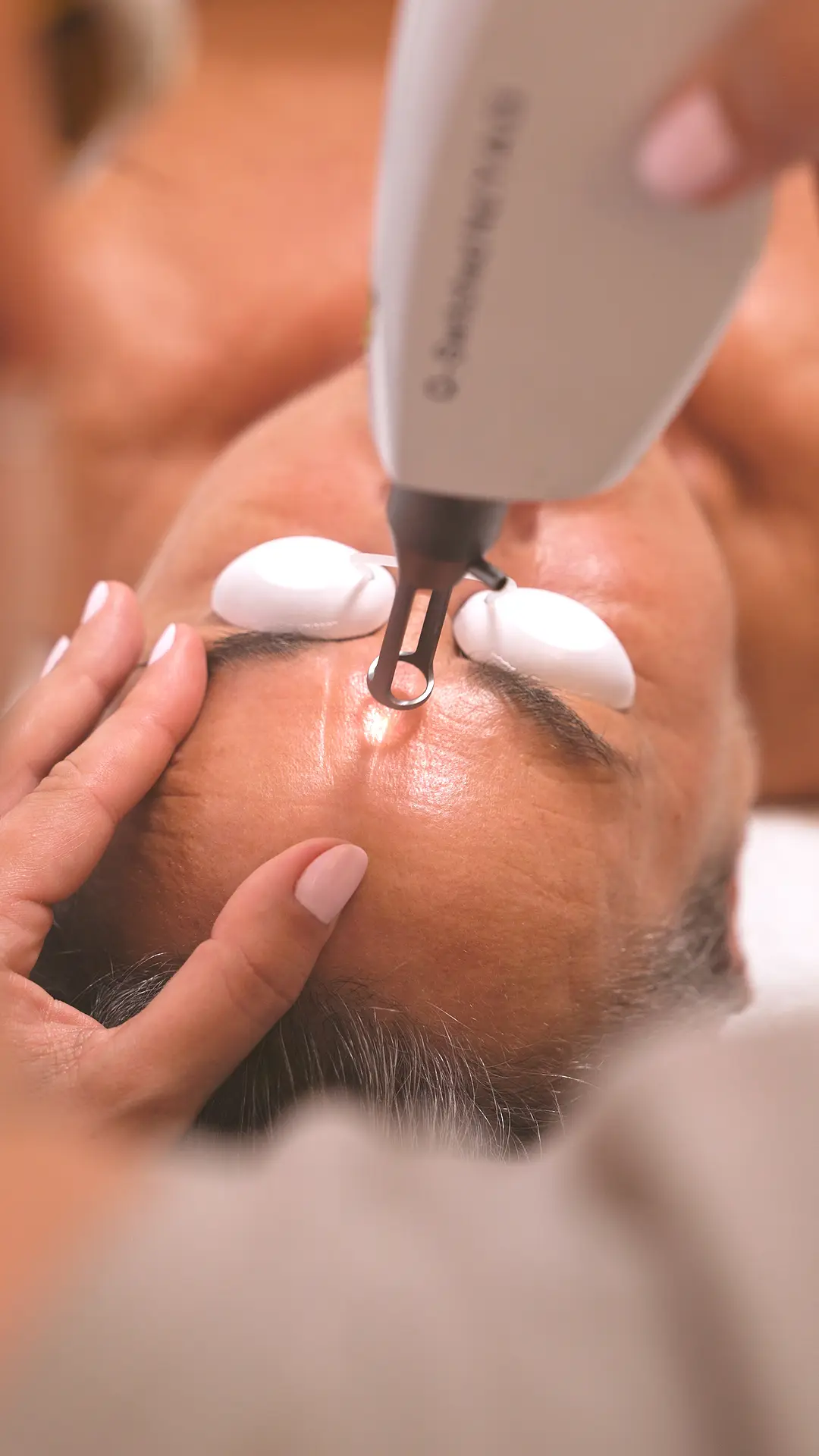 LÁSER ND-YAG Q-SWITCHED